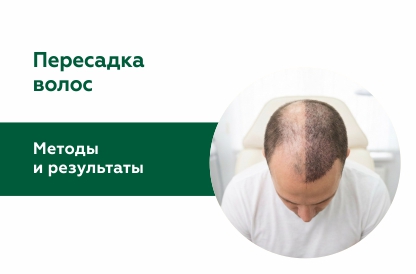 Как проходит пересадка волос